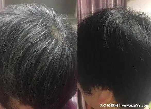 白头发有什么方法变黑3种方法可以改善白发通过饮食就能解决