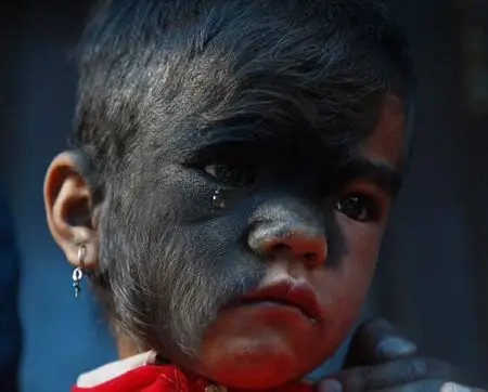 尼泊尔9岁女"毛脸孩"接受手术 曾被视作怪物(组图)