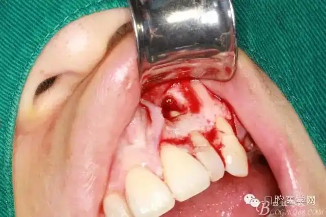 一例左上侧切牙根尖切除术