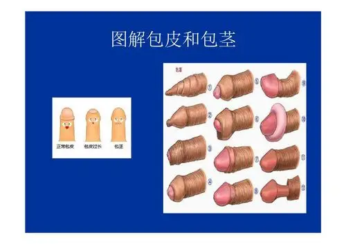 包皮过长和包茎