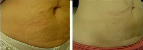 吸脂有哪些危害和后遗症