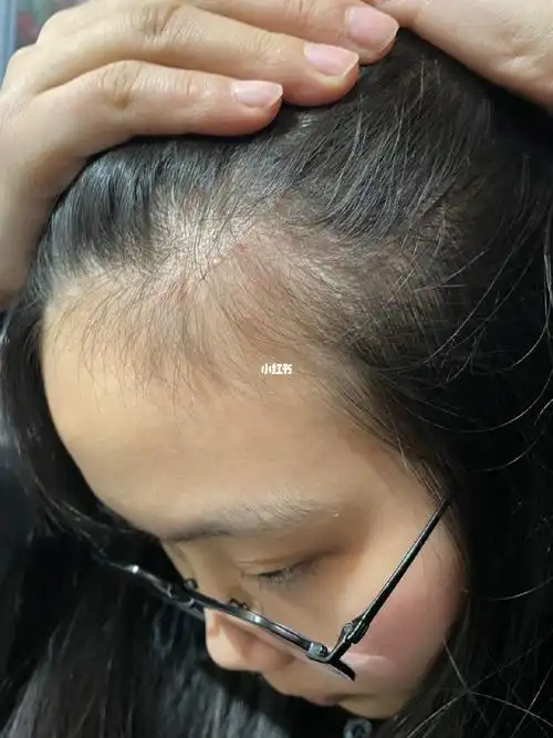 头皮长痘又红又痒怎么办