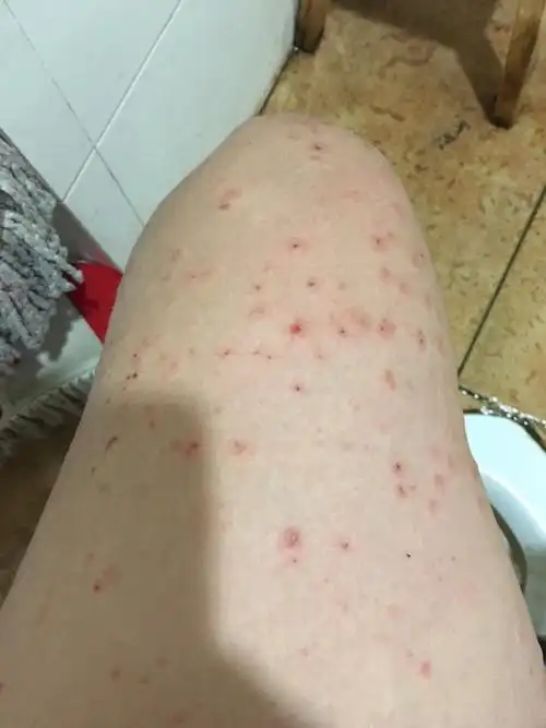 孕后期得了妊娠痒疹,是不是生了就好了,有没有宝妈得过啊?