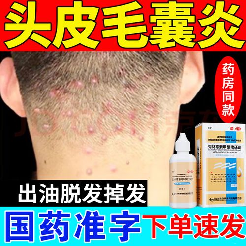 【治毛囊炎药】头皮毛囊炎专用药满头疙瘩溢脂性皮炎毛囊发炎真菌感染
