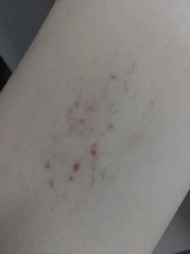 大腿内侧痒痒,挠了几下,就成这样了,如下图!请问是什么问题?