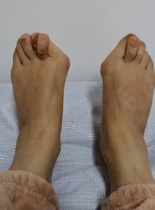 拇外翻合并叠趾畸形,和大拇趾长有很大关系,拇外翻