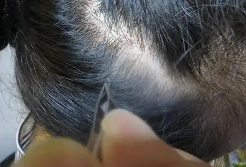 也有网民认为"白头发拔掉后白色素会把其他的黑色毛囊污染从而导致