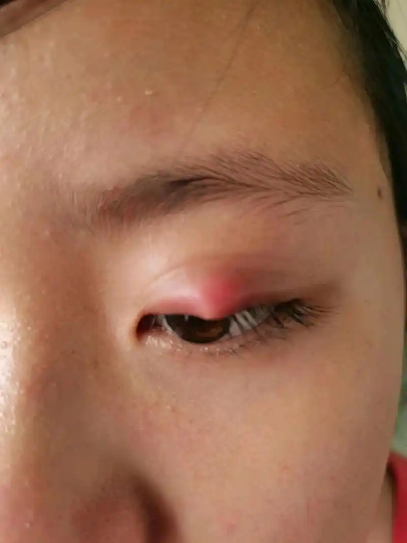 姑娘眼睑上长了个疙瘩,医生建议手术,哪个大神可以告诉我这有没有必要