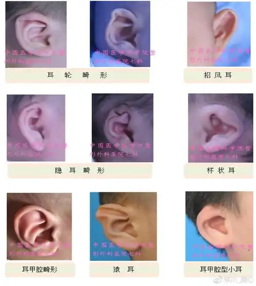 可以非手术矫正的耳畸形种类