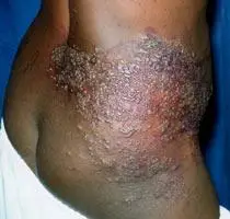 艾滋病患者带状疱疹