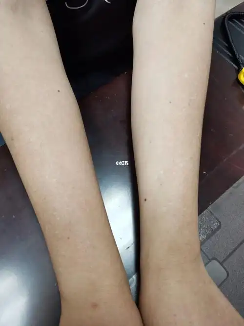 特发性点状白斑