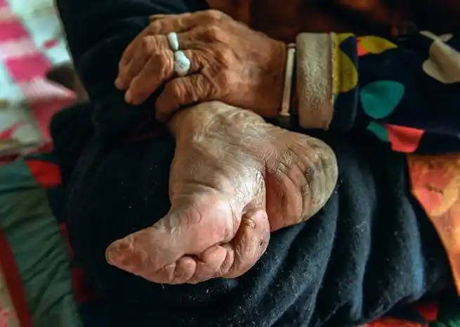 几张图告诉你裹了89年的小脚长什么样子