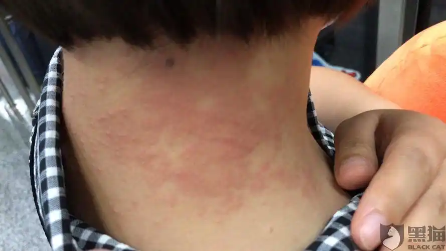 黑猫投诉:京东自营购买索尼挂颈式耳机,导致脖颈处过敏严重,要求京东