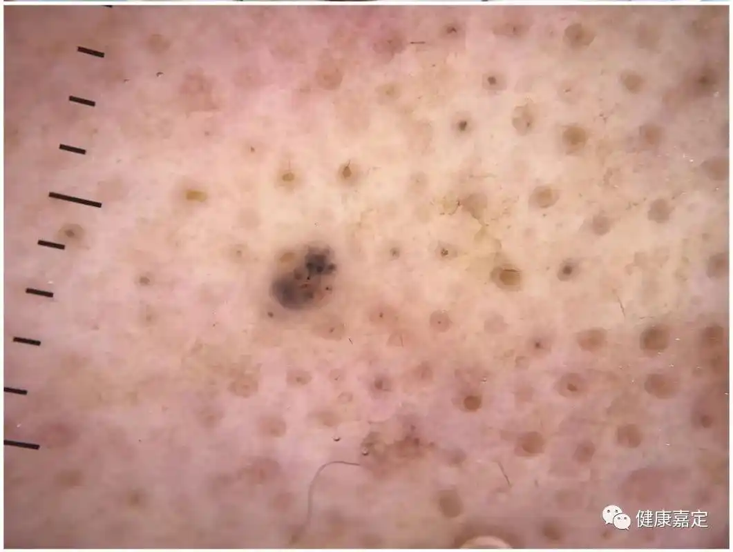 南翔医院发现最小的皮肤恶性肿瘤,一粒仅针尖样大小的"黑痣"