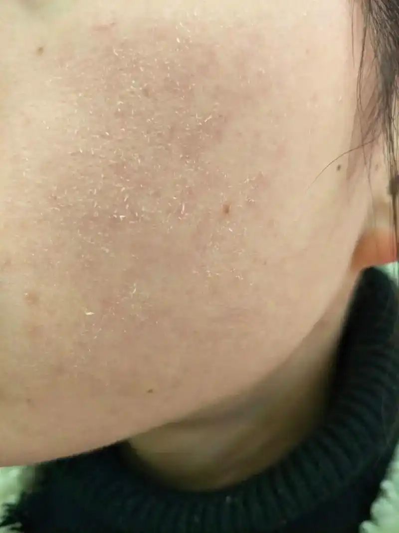 喝水是保湿的直接方法,每天喝充足的水能够让干燥的皮肤看起来更水嫩.