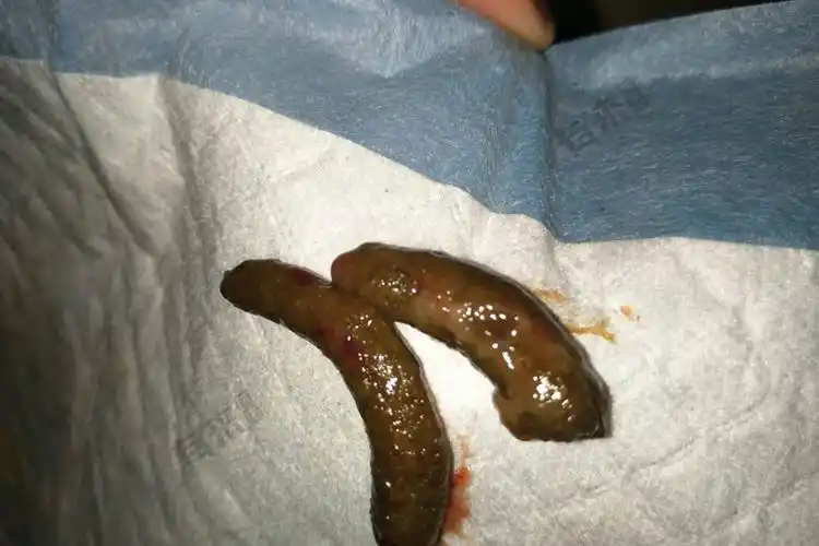 肛门癌的早期症状图片