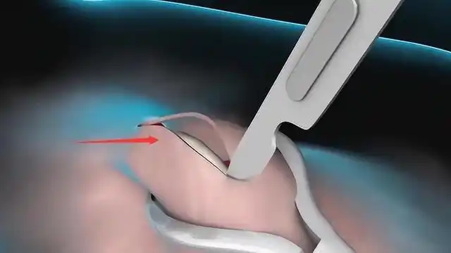 原创宝妈想取掉节育环生二胎,却被医生告知:已错过最佳"取环"时间