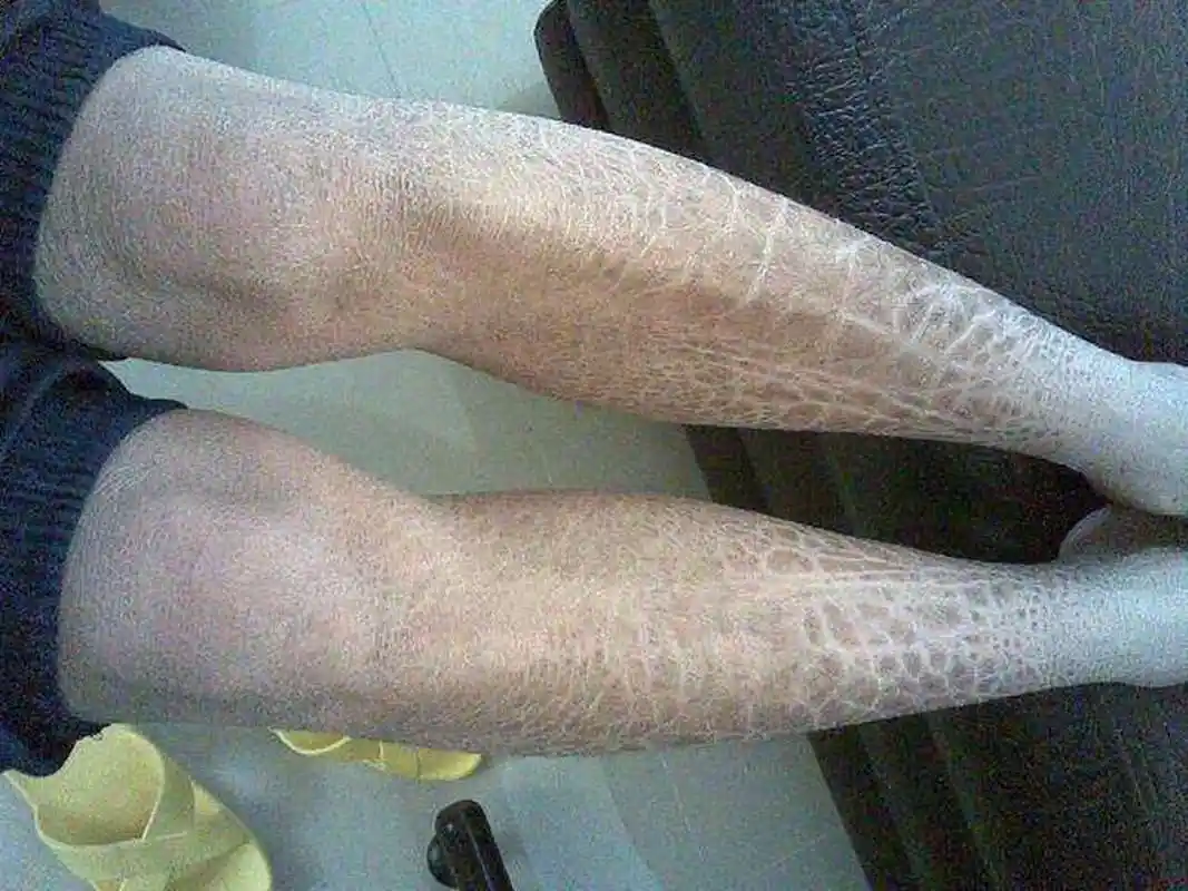 小腿皮肤像"鱼皮",这个方法简单处理 小腿的皮肤像鱼鳞一样干燥,脱屑