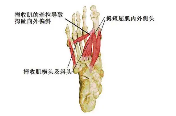 手术治疗:绝大多数拇外翻患者均需接受手术治疗.