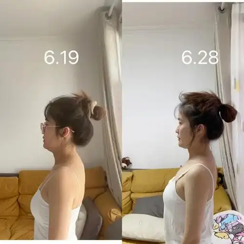 记录驼背头前倾十天真实对比7575