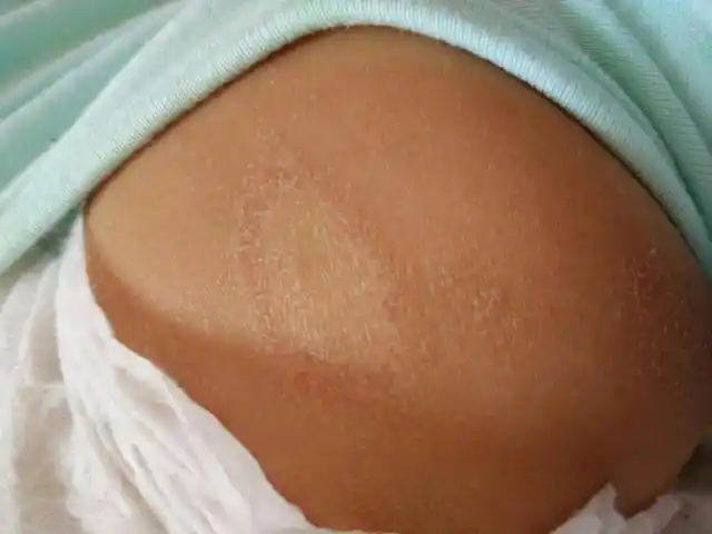 为什么宝宝湿疹反反复复家长第一步就错了搞清楚这两点就对了