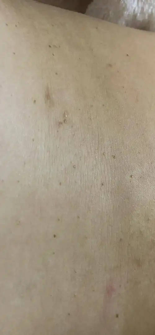 身上扁平疣越来越严重怎么办 以前只有几颗 现在满肚子都是 太.