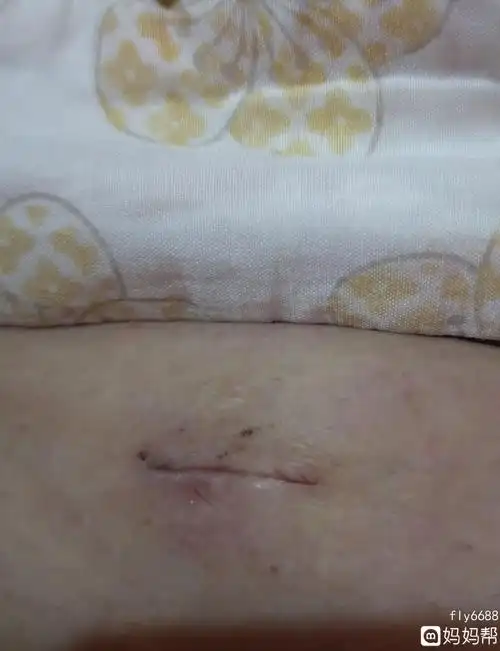 腹腔镜手术后,三个伤口,另外两个都结痂了