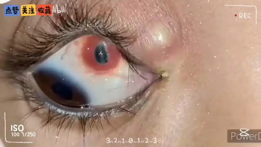 眼睛里长了颗痘痘