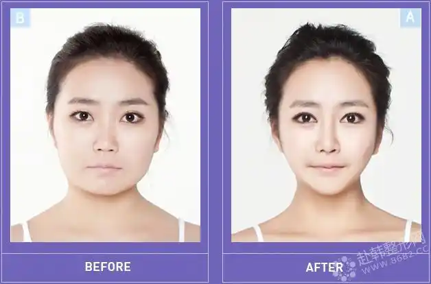 a特整形中心真人整容前后对比图片
