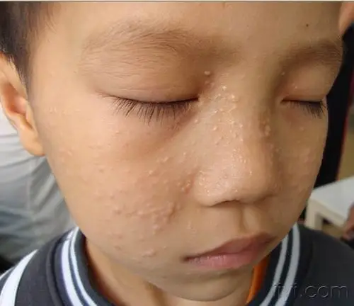 门诊图片12毛发上皮瘤