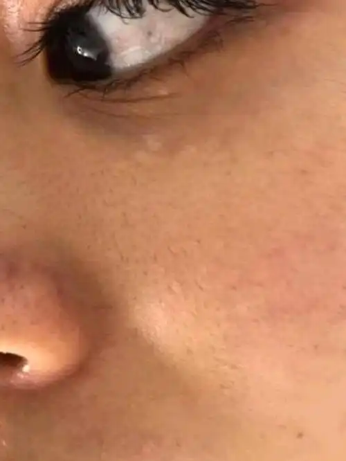 因为经常熬夜,面部黑色素沉淀的比较严重,整个人看起_圈子-新氧美容