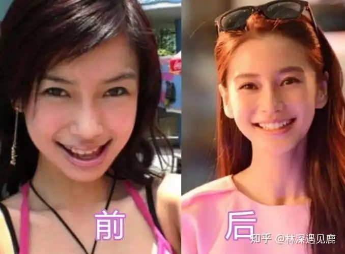 求问宁波整牙的朋友戴过牙套矫正牙齿之后脸型变了吗会变漂亮吗