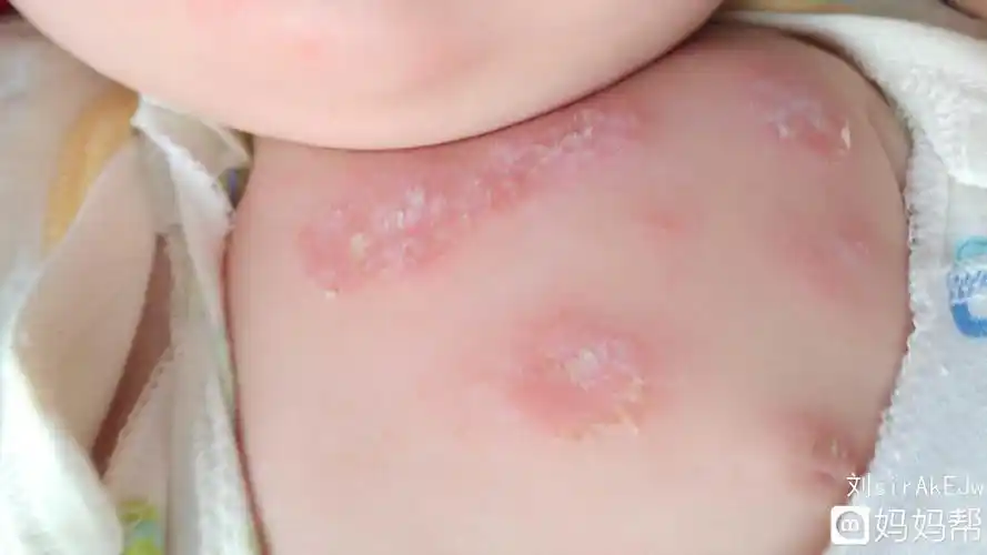 惊喜交集!婴儿面部湿疹怎么办"喜气洋洋"-第2张图片-燕郊博客