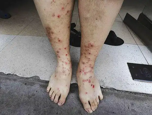 跳蚤咬后是什么样?图片.