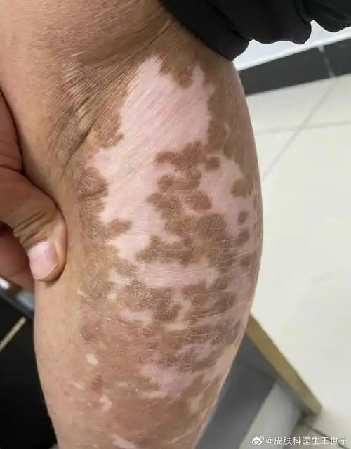 白癜风在皮肤一块块白斑,最容易造成大家的自卑心理,不愿面对外人!