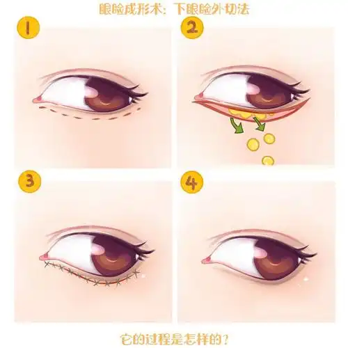 下眼睑手术(选择1): 外切法