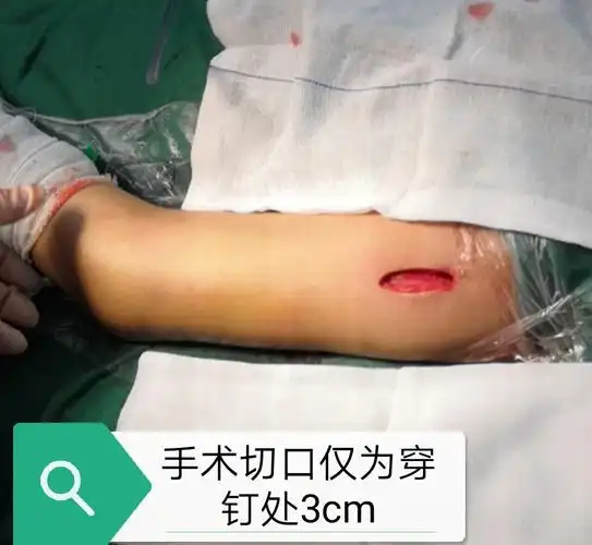 骨科 分享二例儿童骨折闭合复位钛制弹性髓内钉(ten)内固定手术