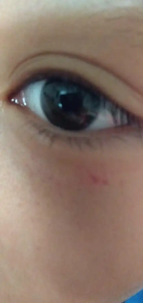 十岁娃下眼睑有小红片怎么回事