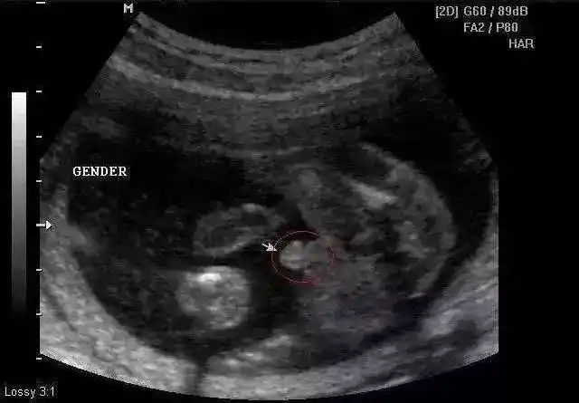 12周胎儿男女生殖图区别图片,nt检查看男女准不准?-医孕帮