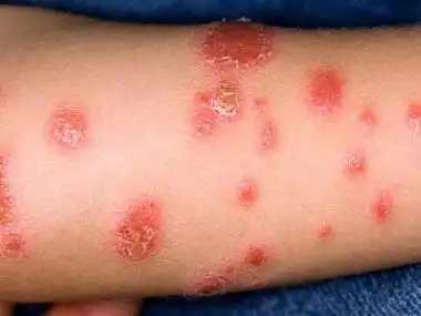 牛皮屑早期图片