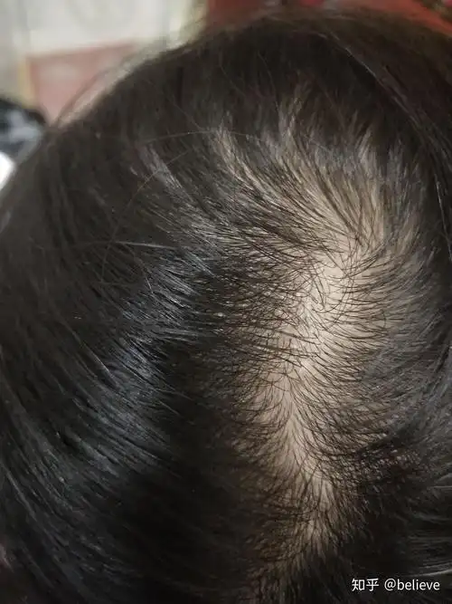 请帮看一下女生这样算秃顶吗