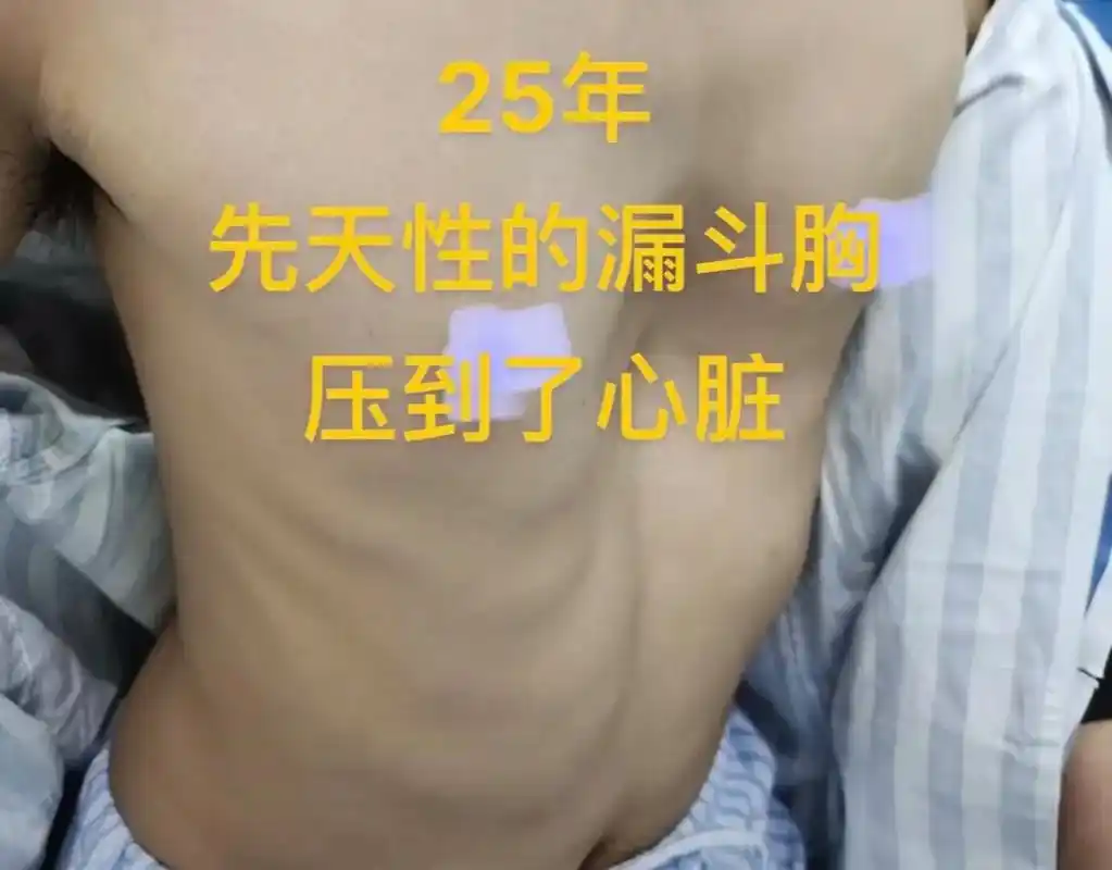 我就是手术做太晚,如果发现孩子胸部有凹陷一定要重视起 - 抖音