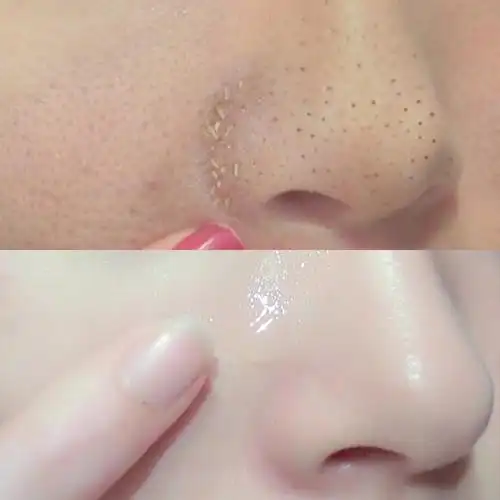 电动吸黑头神器 去粉刺收缩毛孔清洁器脸部洁面导出去螨虫_7折现价207