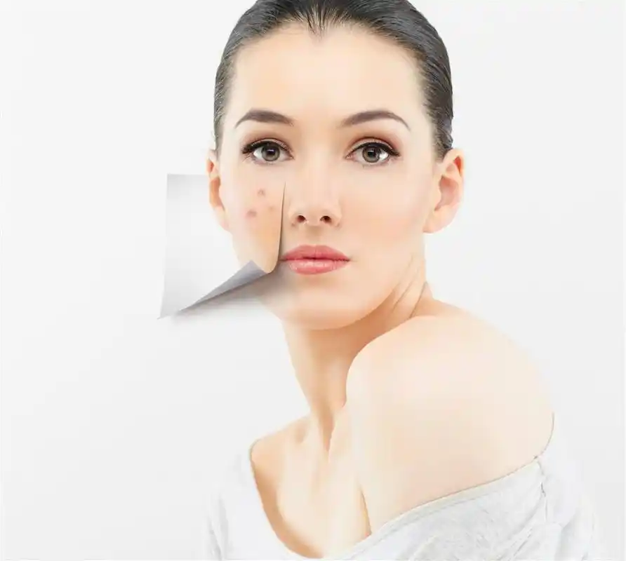 zsks祛痘修复凝胶:这才是痘痘痤疮发生的4大原因