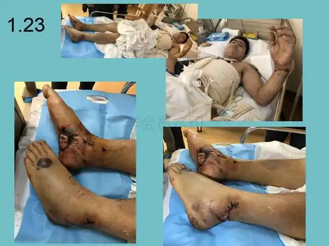 吴希瑞老师病例分享--坠落伤