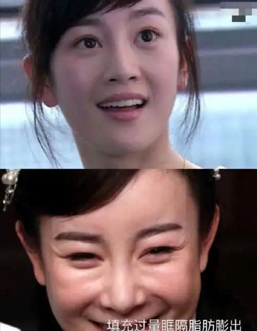 这些明星,泪沟真的太严重了!