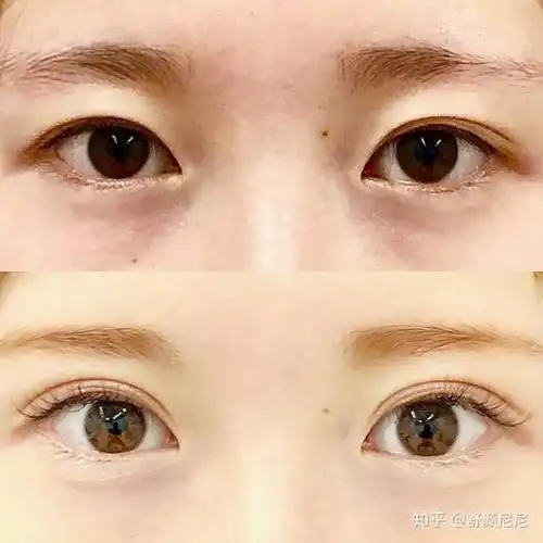 埋线双眼皮效果好吗,?
