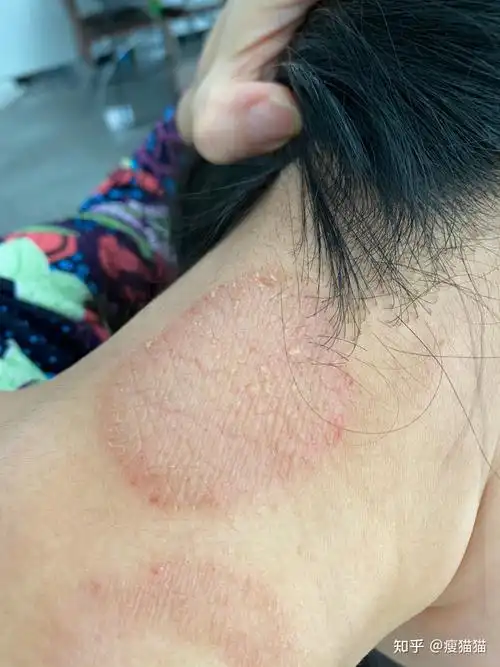 偶染神经性皮炎社区医院手到病除 - 知乎