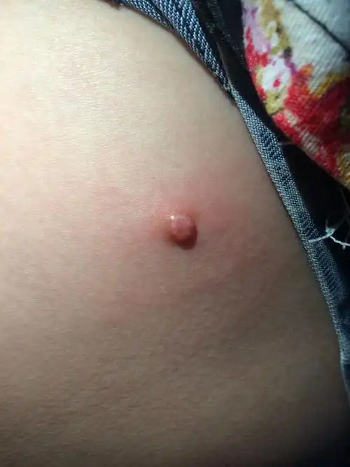 急急急急急急!最近脚上长了个肉疙瘩还有点痒 不会是瘤吧0505