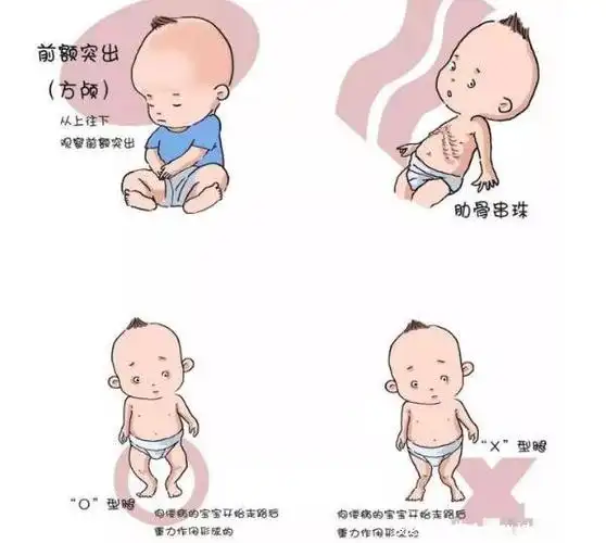 方颅图片和正常对比,缺钙导致的畸形佝偻病症状